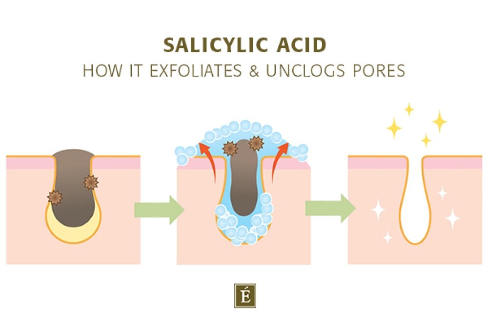 Comment l'acide salicylique exfolie et exfolie  débouche les pores