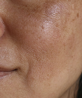 combattre l'hyperpigmentation cutanée estivale et le pigment cutané irrégulier