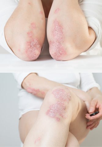 dyschromie et psoriasis