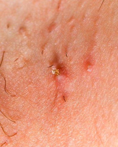 ingrown hair symptoms