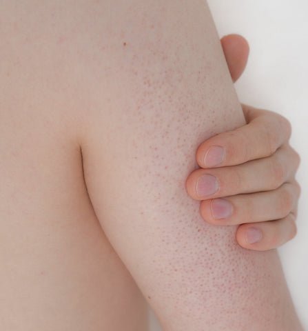 keratosis pilaris atopic sensitivity