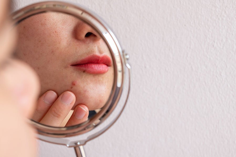 Une photo recadrée d'une femme s'inquiète de son visage lorsqu'elle a vu le problème de l'acné se produire sur son menton par un mini miroir.  Photo conceptuelle de l'acné et de la peau problématique sur le visage féminin.